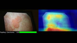 Cancerous Lesion Detector with Explanatory Gradcam in Cystoscopy