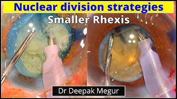 Small Rhexis - How to divide the nucleus..? Phaco Basics. Dr Deepak Megur