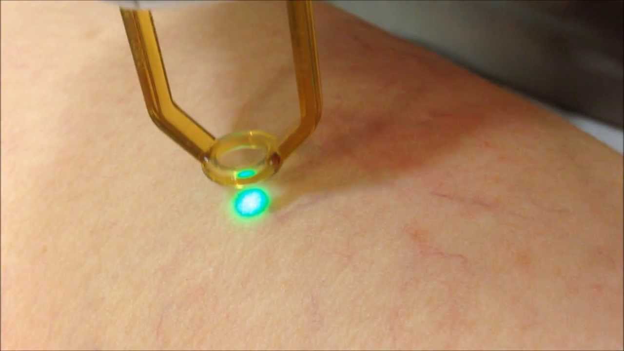 Laser Treatment of Spider Veins at CHIC MedAesthetic Clinics YouTube