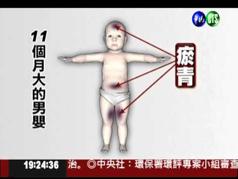 男嬰嗆水送醫 全身瘀傷疑受虐