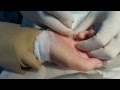 Trigger finger или Щелкающий палец - процедура малоинвазивной лигаментотомии