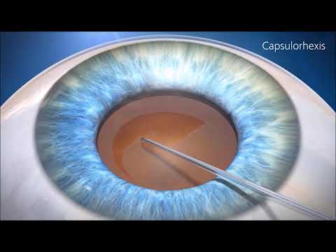 Tratamentul Cataractei Video Explicativ