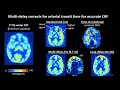 Advanced medical imaging to measure brain blood flow