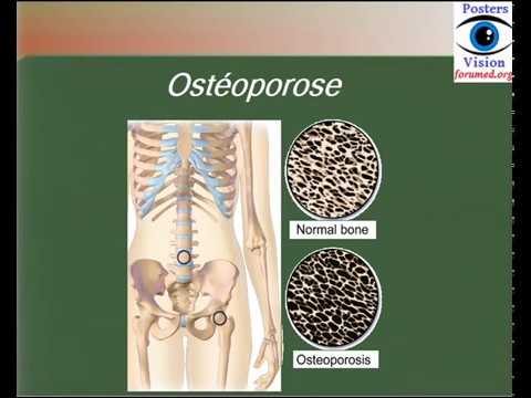 Ostéoporose définition  et les facteurs de risque