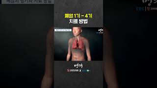 폐암 3기는 어떻게 치료할까?