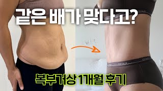 출산 후 복구 되지 않던 처진 뱃살... 수술하니 아이들이 더 좋아해요🥰 | 복부거상 1개월 후기 | 처진살수술