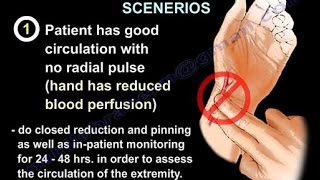 Supracondylar Fracture Humerus & Circulation - Everything You Need To Know - Dr. Nabil Ebraheim