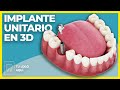 IMPLANTE UNITARIO 🦷 Vídeos dentales 3D - Pedagogía pacientes de Clínica Dental - Odontología en 3D