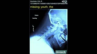 "Breech" By The Missing Youth