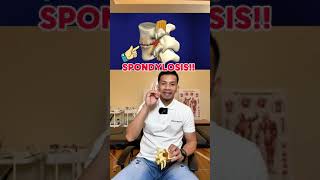 What is SPONDYLOSIS?