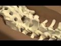 Simulated Spinal Cerebrospinal Fluid Leak Repair