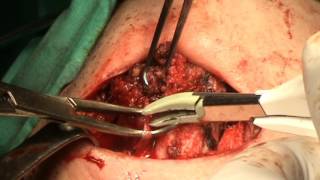 Zob Əməliyyatı Completion thyroidectomy