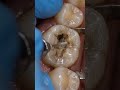 The Hidden Black Pit – Deep Molar Cavity Restoration 🦷✨Hashtags:#DentalRestoration #SatisfyingVideo