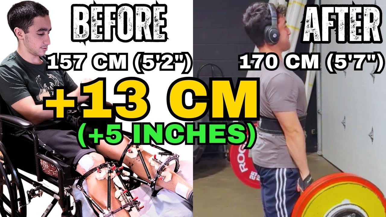 От инвалидного кресла до пауэрлифтинга: возвращение Адама к тренировкам после увеличения длины ко...