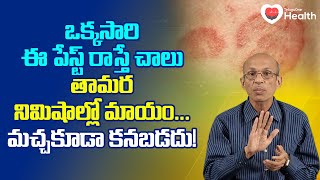 Ringworm త మర న మ ష ల ల మ య మచ చ క డ కనపడ?