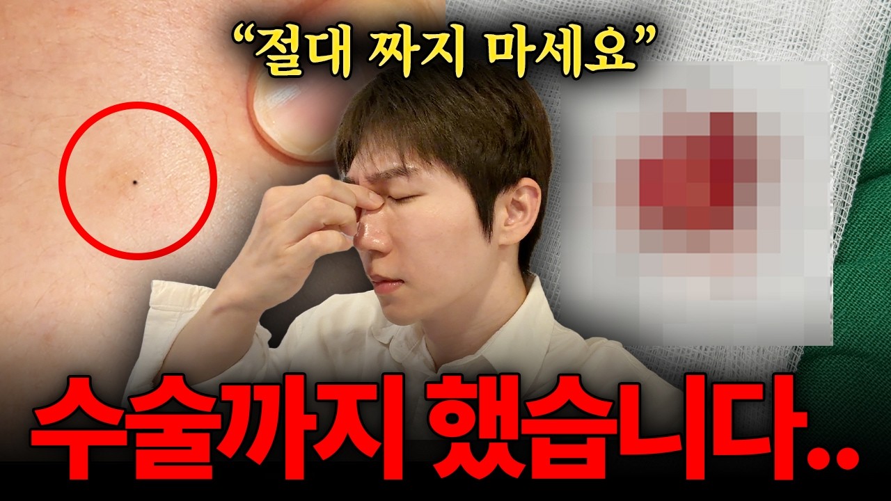 여드름인 줄 알았는데 수술까지 했네요.. 무조건 병원가세요. (피지낭종)