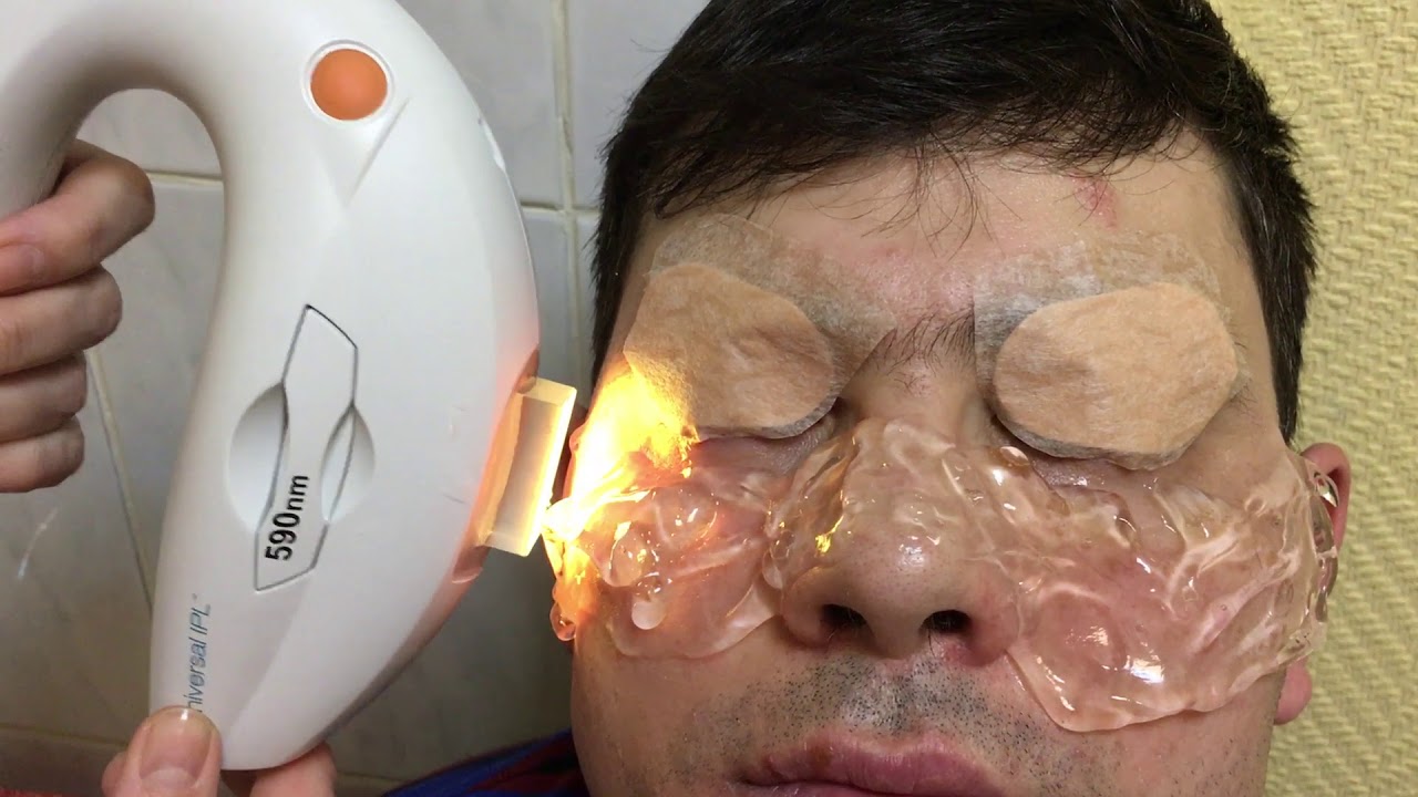 Лечение сухого глаза Lumenis, m 22. ДМЖ, процедура (3) - YouTube