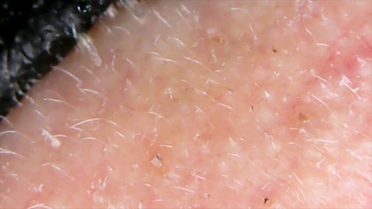 Pore Strip Removing Blackheads YouTube