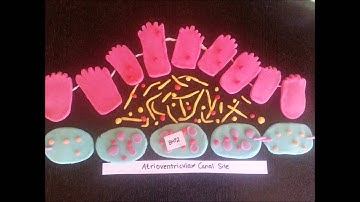 Atrioventricular Canal Epithelial to Mesenchymal Transition