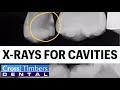 Case of the Week - X-Rays for cavities