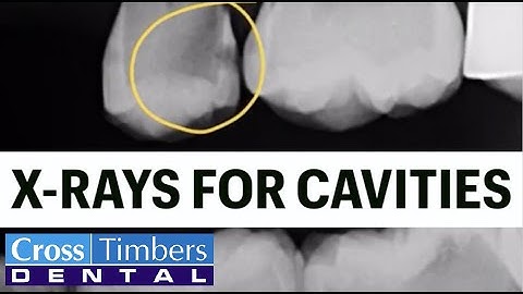 Case of the Week - X-Rays for cavities