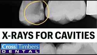 Case of the Week  XRays for cavities