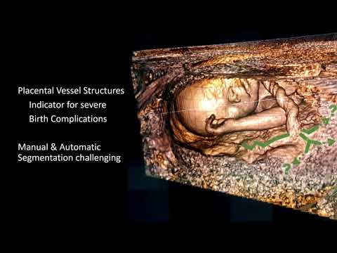 Towards Placental Surface Vasculature Exploration in Virtual Reality
