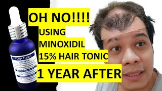 MINOXIDIL 15% Hair Tonic Results after 1 year - 2021 (Surprising OUTCOME!)