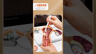 Endometrial Thickness for Pregnancy in Telugu | Endometrium Lining for Embryo Transfer #IVF Success