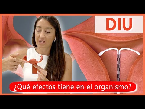 Video: ¿Qué son las espirales anticonceptivas?