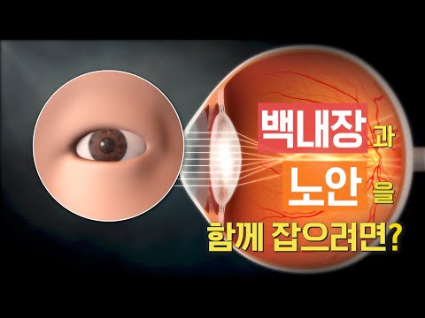 백내장과 노안을 한번에 잡는 인공수정체 | 백내장 | <strong>노안</strong> |  명의 | #EBS건강