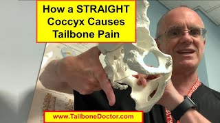 How a STRAIGHT Coccyx Causes Coccyx Pain (Tailbone Pain, Coccydynia)