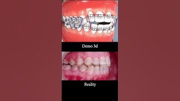 3D and realistic braces