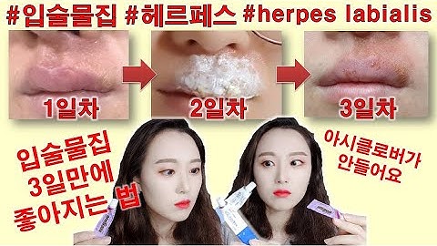 SUB) 아시클로버도 소용없는 입술물집 3일만에 좋아지는 방법(물집대환장파티) herpes labialis