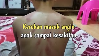 Kerokan masuk angin anak sampai kesakitan || Kerokan masuk angin terbaru