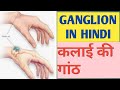 GANGLION IN HINDI,/GANGLION CYST/MEANING OF GANGLION IN HINDI