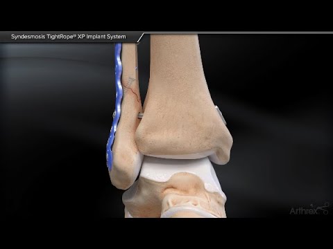 Syndesmosis TightRope® XP Implant System 