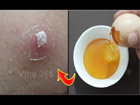 Mụn trứng cá, mụn ẩn dưới da sẽ hết sạch với 3 cách trị mụn đơn giản bằng lòng trắng trứng gà này