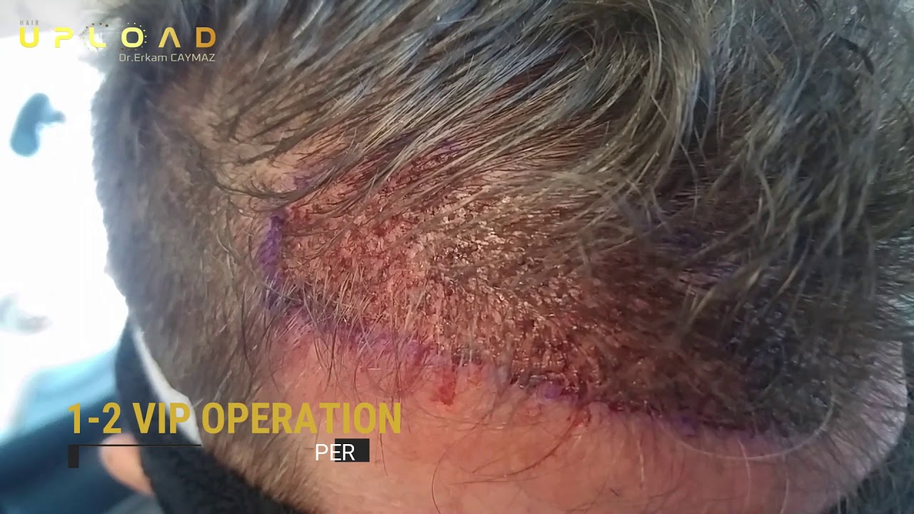 Unshaven Hair Transplantation