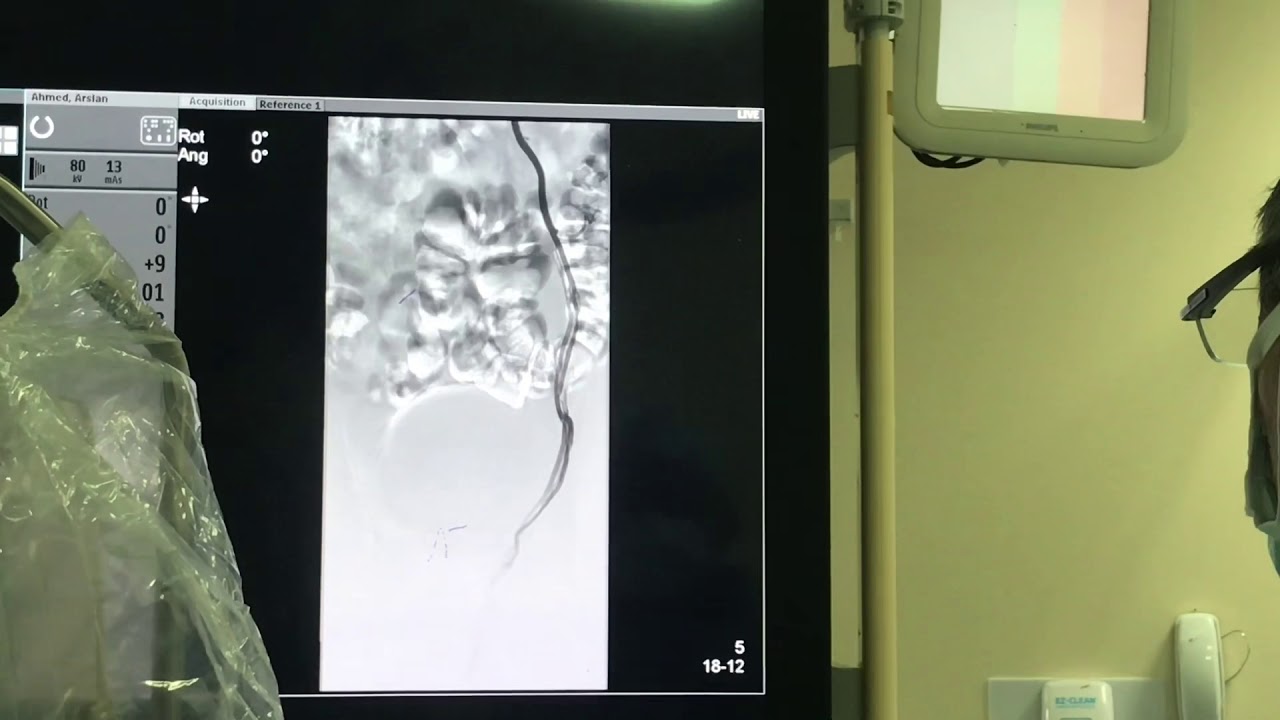 Varicocele Embolization Treatment in Urdu Pakistan guided adventure