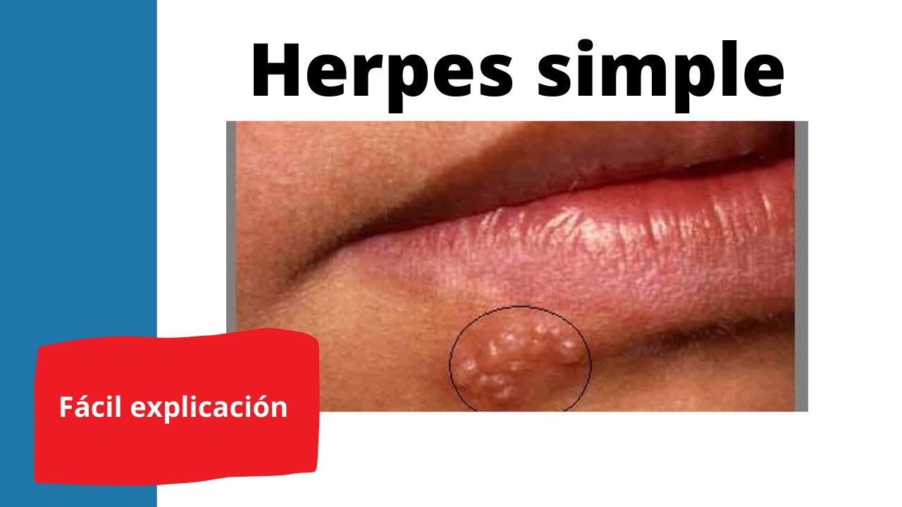 Herpes en la nariz