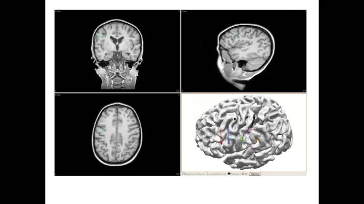Development of an SEEG Program in Pediatric Epilepsy Surgery: Case Studies