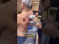Cupping is therapy. #news #cuppingtherapy #kampalauganda