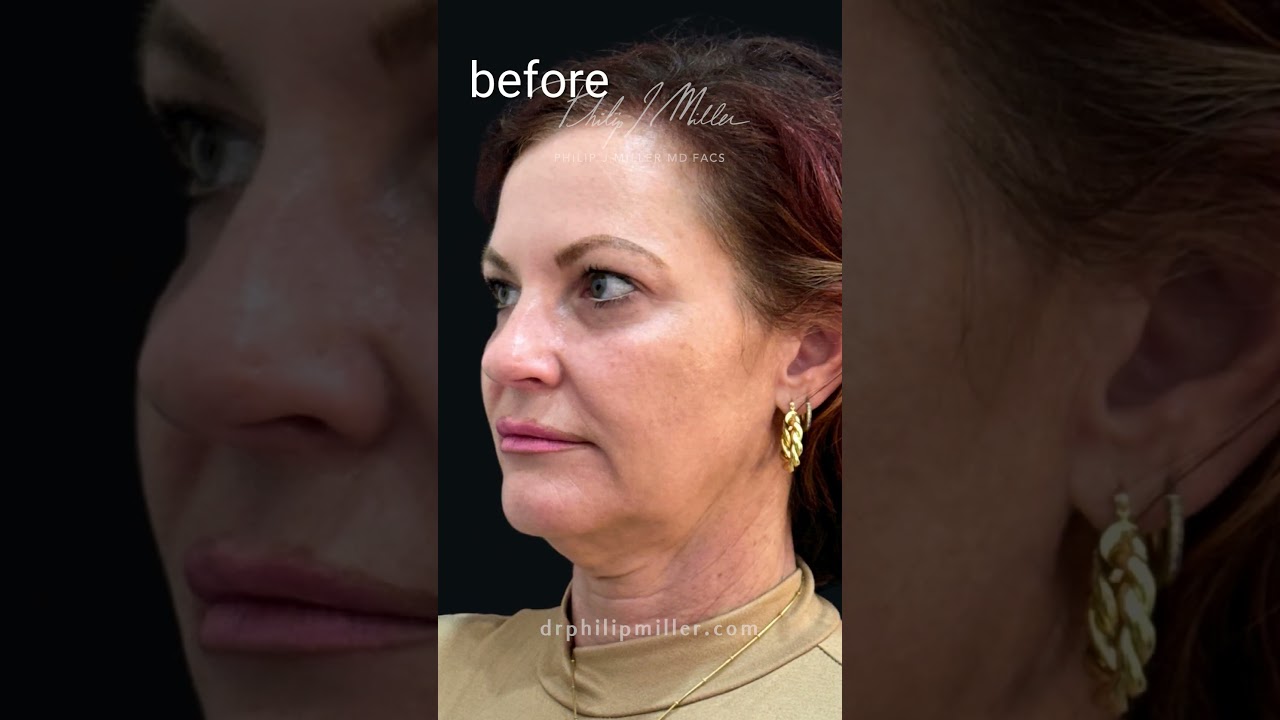 3 months post op MicroLift-Face&Neck