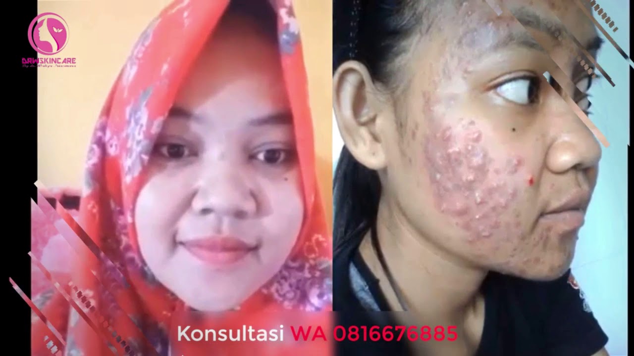 Cara Pakai Drw Skincare Ac1 - Youtube