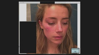 Johnny Depp's lawyers question alleged injuries Amber Heard documented after altercation with Depp