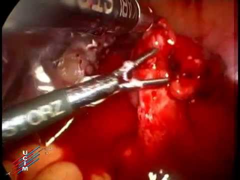 embarazo ectopico roto