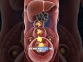 The Silent Killer: Cholesterol Disease Explained(Don’t Ignore These Signs!)#Cholesterol #HeartHealth