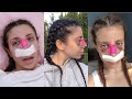 I GOT A NOSE JOB & THIS IS THE RECOVERY VLOG!