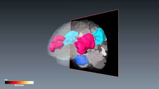 Surface Rendering and Rotation of Human Brain